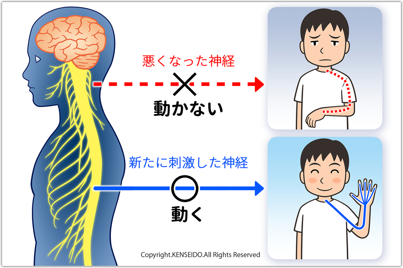 椎間板ヘルニアでお困りの方へ